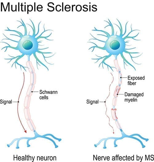 Multiple sclerosis diagram