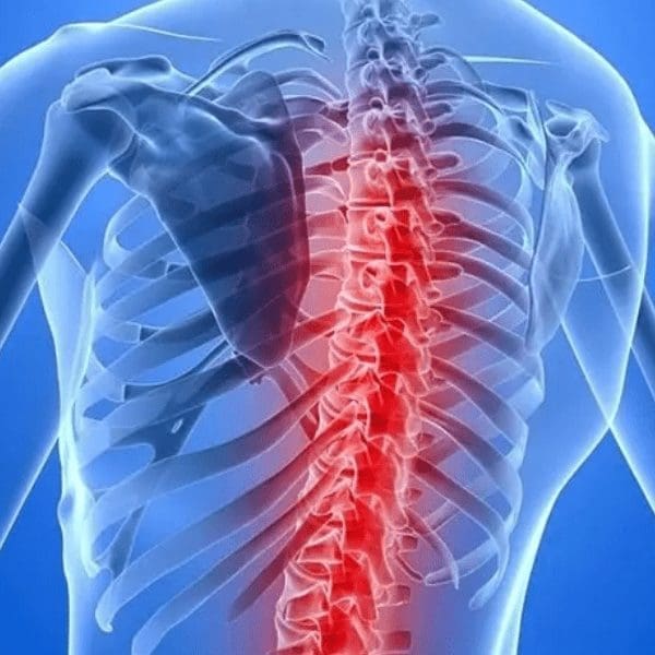 illustration of Spinal Muscular Atrophy