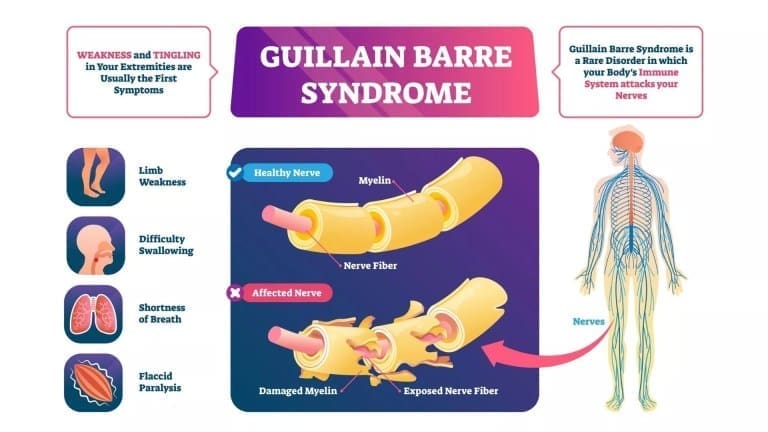 3 guillain barre syndrome treatment propel physiotherapy