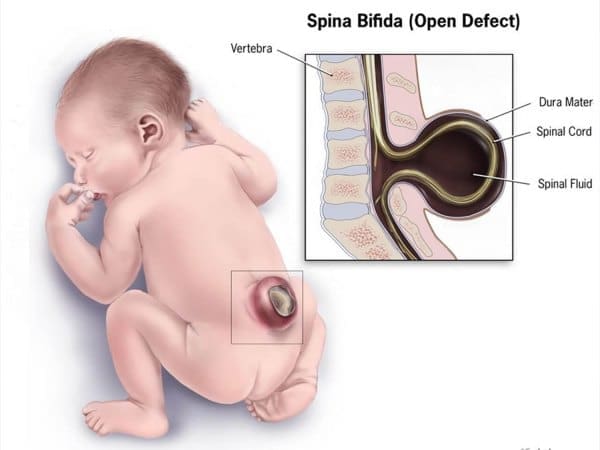 4 spina bifida