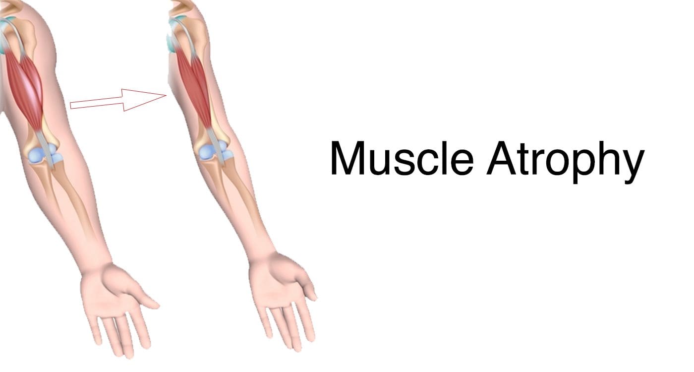 muscle atrophy
