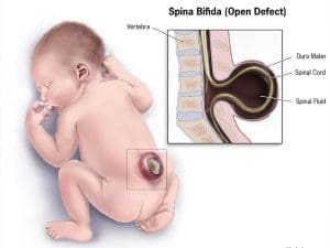 5 spina bifida