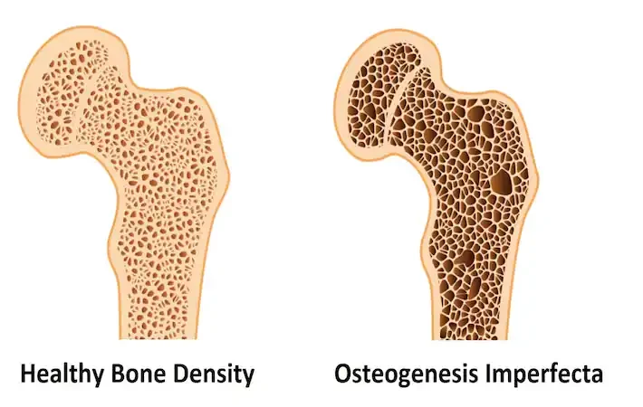 brittle bone disease e1724421471790