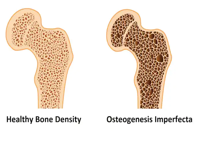 What is Osteogenesis Imperfecta? Dubai Mobility