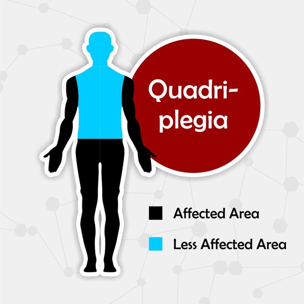 What is quadriplegia diagram